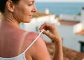 Eritema solare: rimedi immediati e come prevenirlo