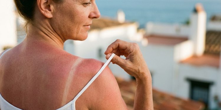 Eritema solare: rimedi immediati e come prevenirlo